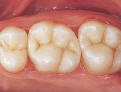 Tooth Colored Fillings - After