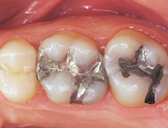 tooth colored fillings - before