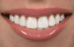 Beautiful porcelain veneers Birmingham AL