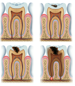 Stages of Tooth Decay endodontics Birmingham AL