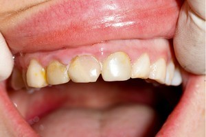 Teeth before treatment dentist birmingham AL