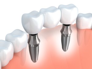 Multiple Dental Implant