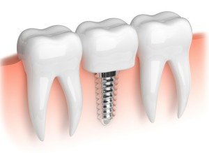 Single Dental Implant