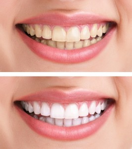 Teeth Whitening Birmingham Dentist