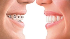 invisalign-vs-braces