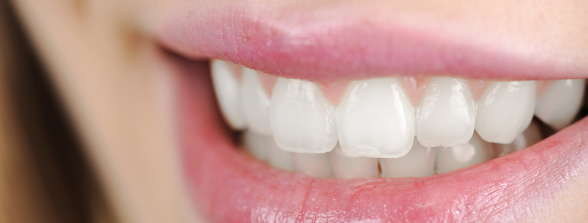 invisalign